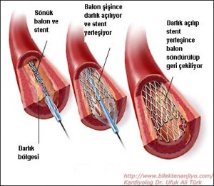 Stent